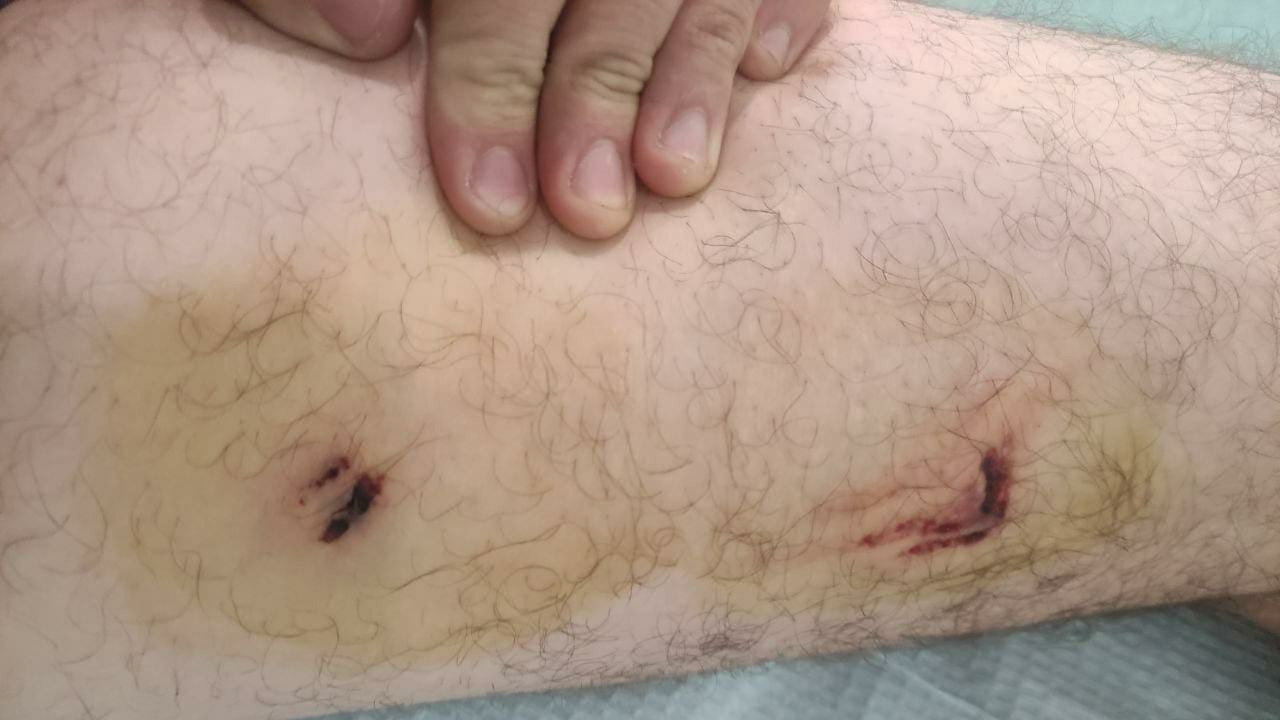Aggredito da un pitbull nell'area dello spaccio: "Mentre mi mordeva i tossici ridevano"