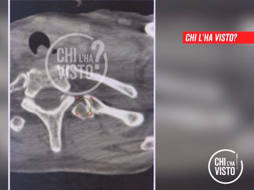 Caso Resinovich, parla il tecnico: "Vi dico perché ho rotto la vertebra a Lilly"