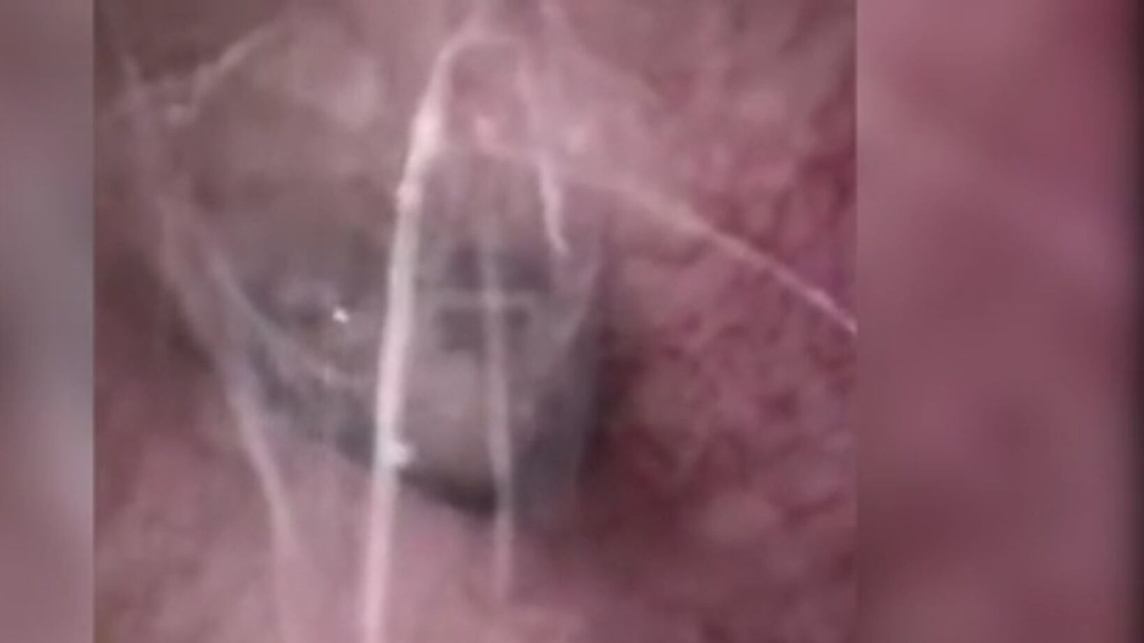 Ragno nell'orecchio di paziente, scoperta choc di un medico in Cina