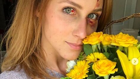Pubblica foto "troppo scollata" sui social. Melissa massacrata di botte dal fidanzato