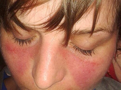 Lupus eritematoso sistemico e coronavirus: troppe fake news