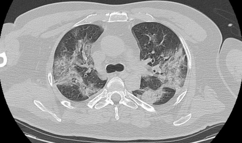 Paziente con lesioni polmonari da Covid-19