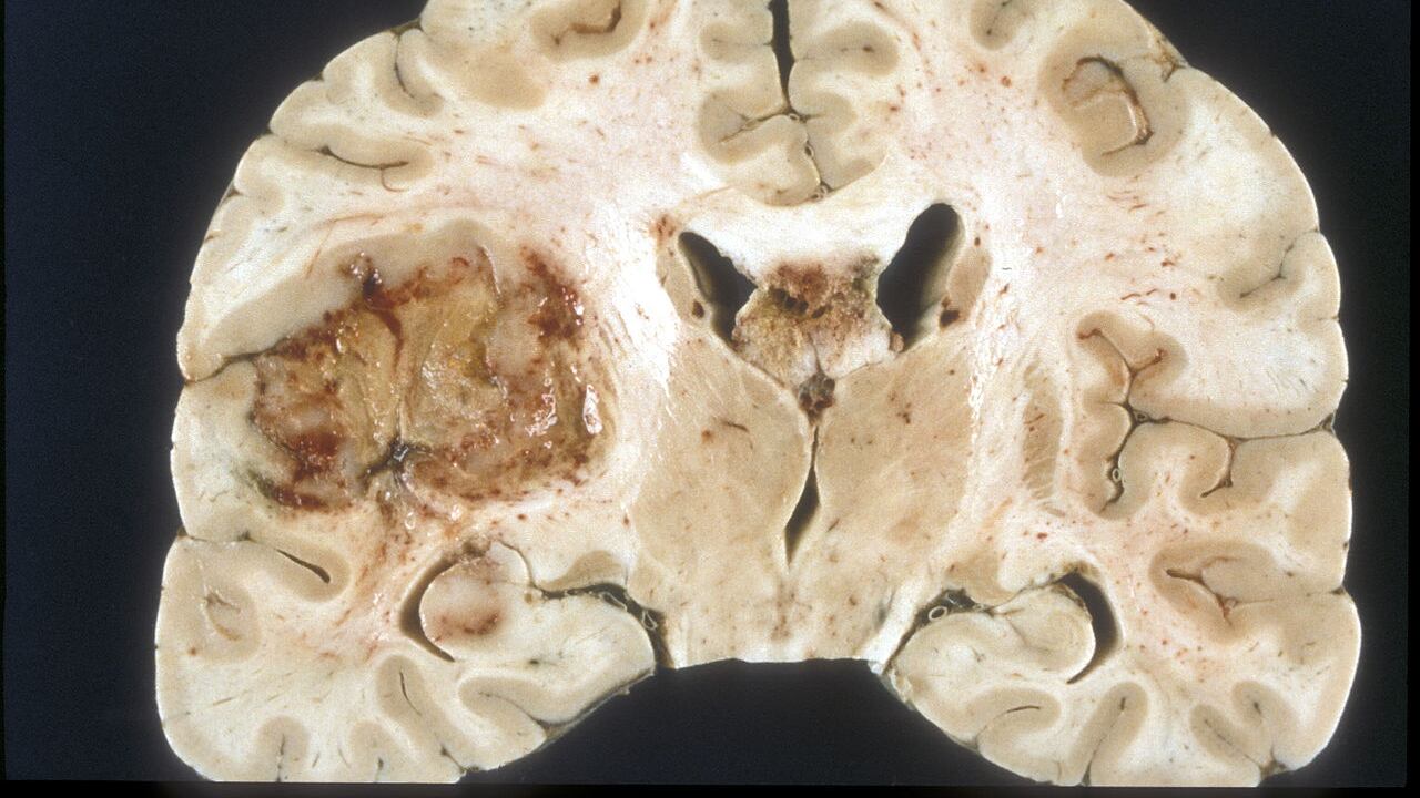 Glioblastoma, nuove speranze per la forma più grave di tumore al cervello