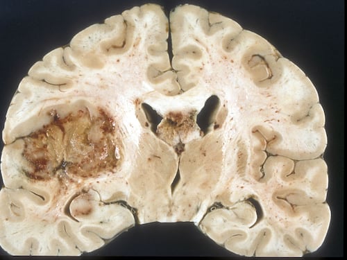 Glioblastoma, nuove speranze per la forma più grave di tumore al cervello