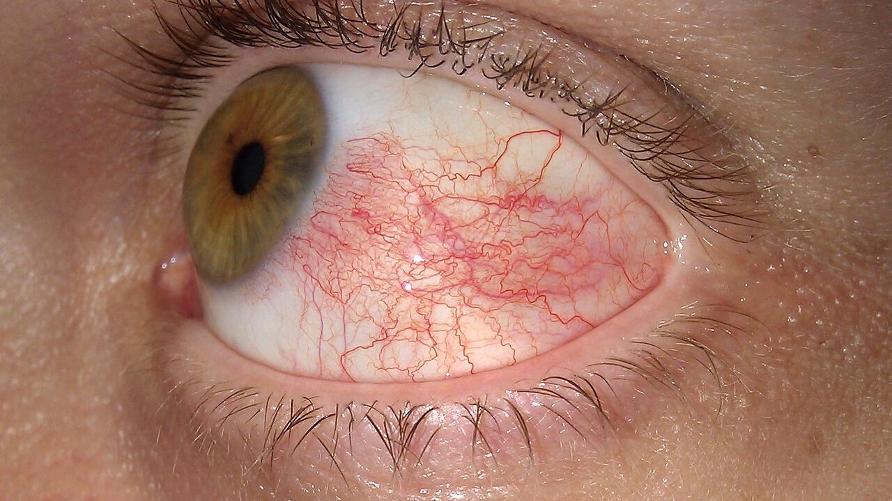Uveite, quali sono i sintomi dell'infiammazione
