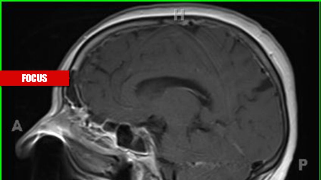 Il nervo olfattorio è la via d'ingresso: così Covid colpisce il cervello