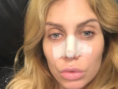 Paola Caruso operata d'urgenza al naso dopo una "borsettata"