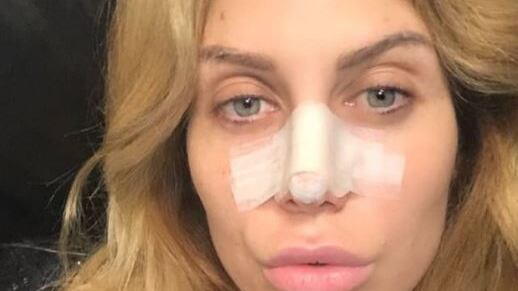 Paola Caruso operata d'urgenza al naso dopo una "borsettata"