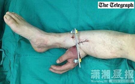 Perde una mano e i medici la attaccano alla gamba 1