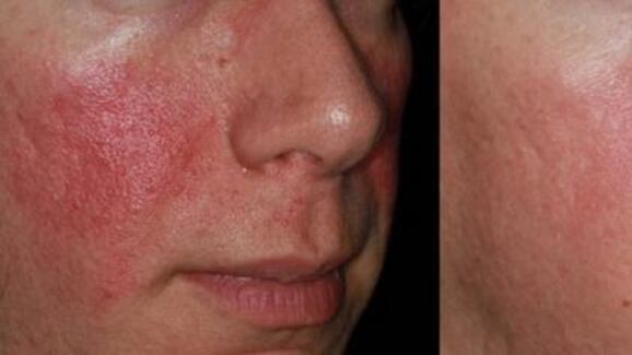 Trattare l'Acne Rosacea: le nuove terapie
