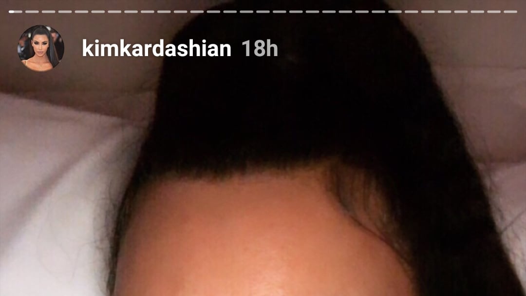 Kim Kardashian si mostra senza trucco e con la psoriasi