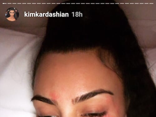 Kim Kardashian si mostra senza trucco e con la psoriasi