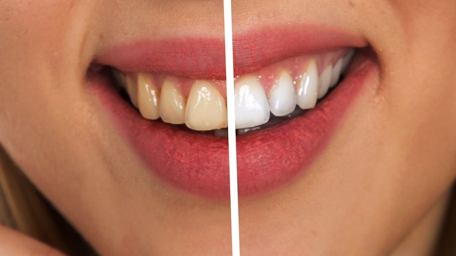 Faccette dentali, il "miracolo" per un sorriso perfetto