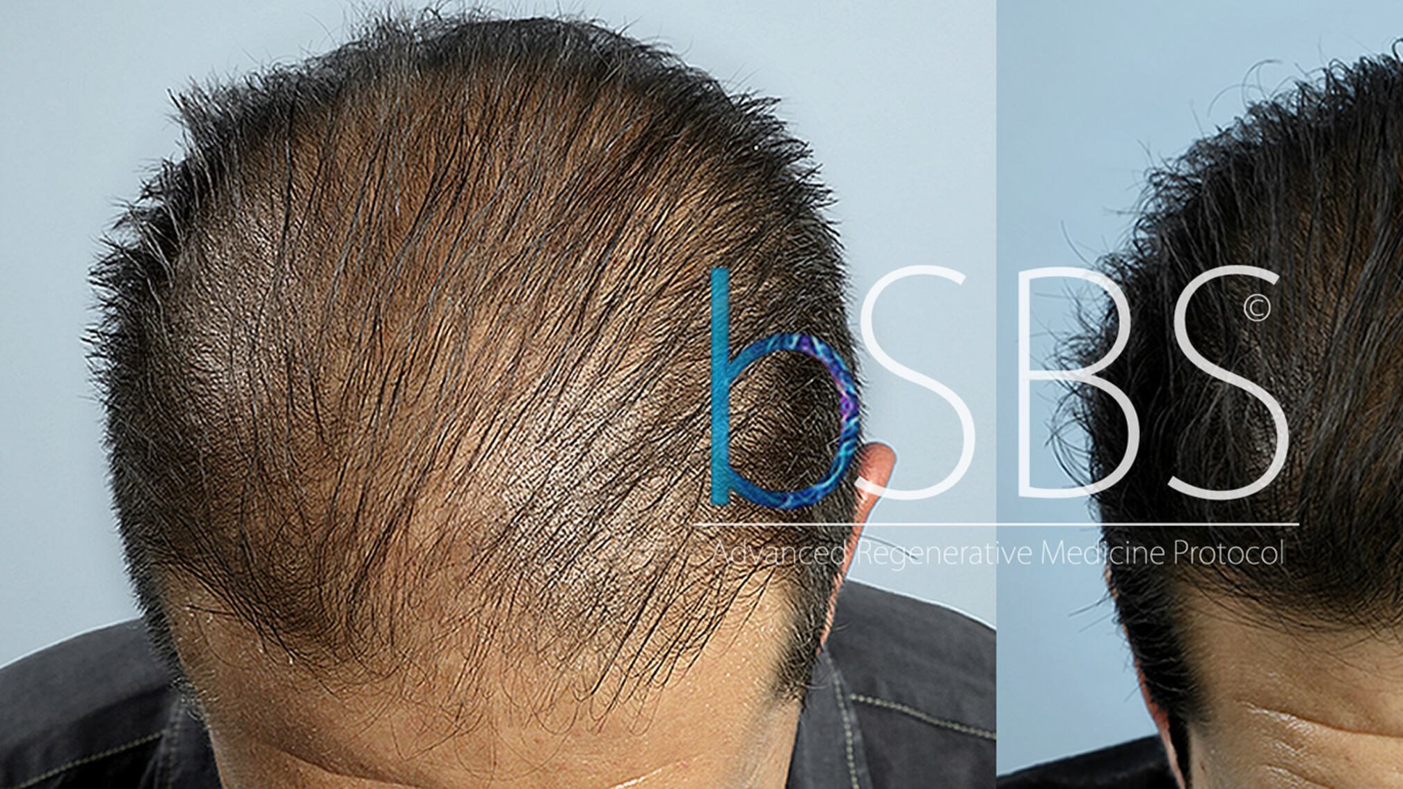 Curare la calvizie? Rigenerazione follicolare al top nella cura della alopecia grazie alle proprie Cellule Staminali