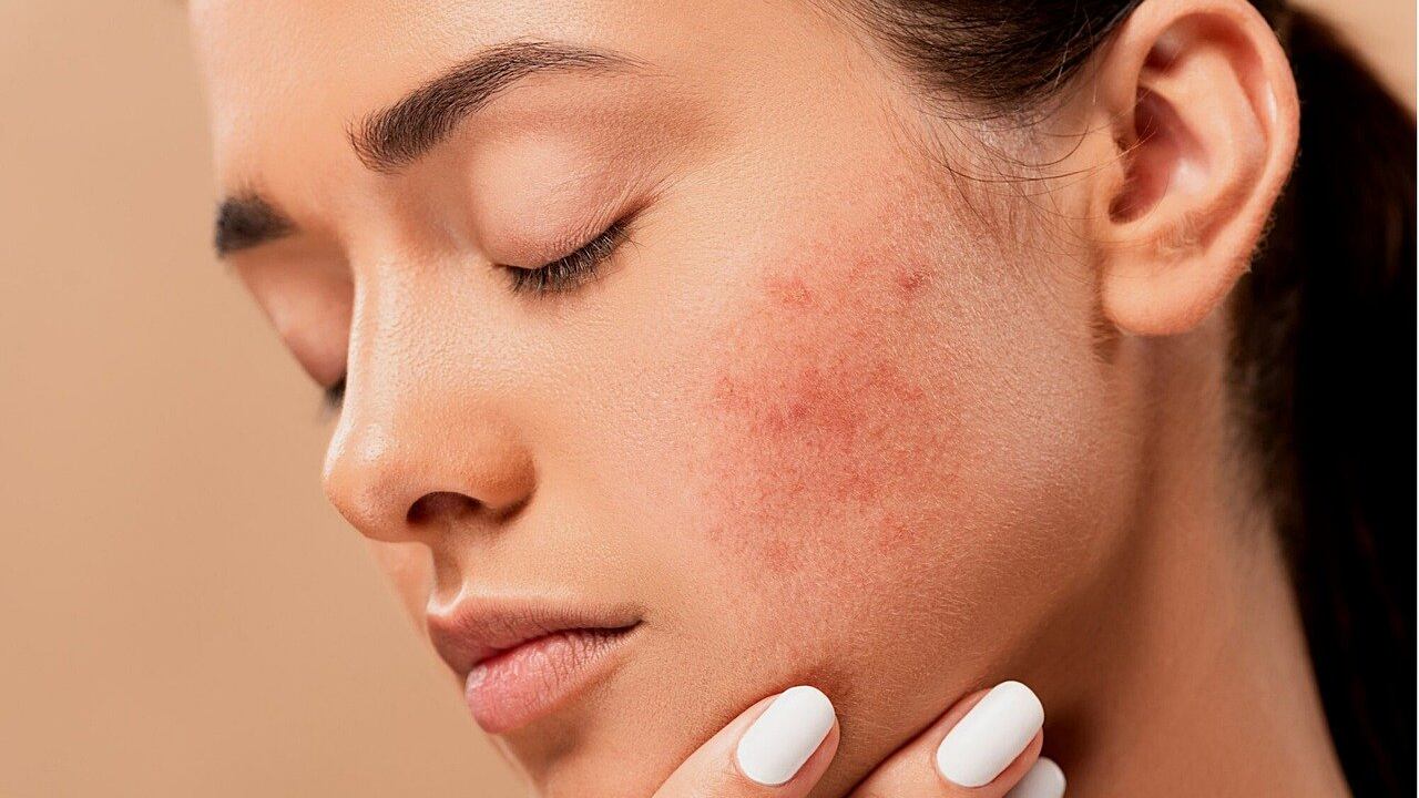 Rosacea o couperose, ecco come si manifesta