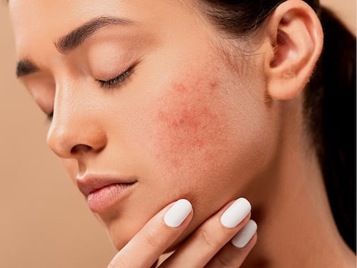 Rosacea o couperose, ecco come si manifesta