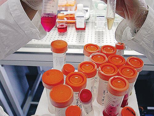Staminali, ok primi test per Sla: trapiantate cellule su sei pazienti
