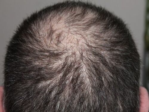 Si fa il trapianto di capelli e muore all'improvviso per una reazione allergica