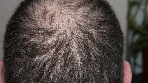 Si fa il trapianto di capelli e muore all'improvviso per una reazione allergica