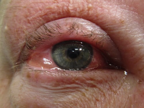 Sindrome di Reiter, quali sono i sintomi?