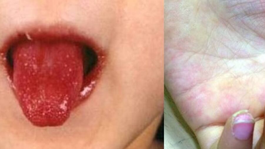 Malattia di Kawasaki: cos'è, chi colpisce e i sintomi