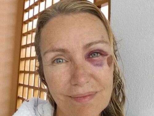 Brutto infortunio per Licia Colò. "Ho rischiato di rompermi la testa"