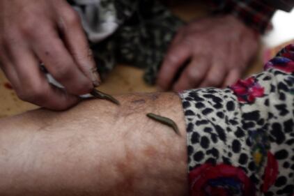 La terapia delle sanguisughe nel Kashmir indiano 3
