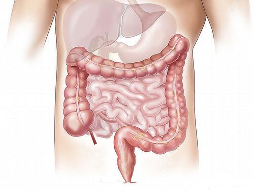 Tumore al colon, uno studio rivela i principali fattori di rischio. I 5 sintomi da riconoscere