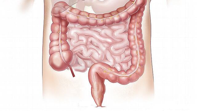 Tumore al colon, uno studio rivela i principali fattori di rischio. I 5 sintomi da riconoscere