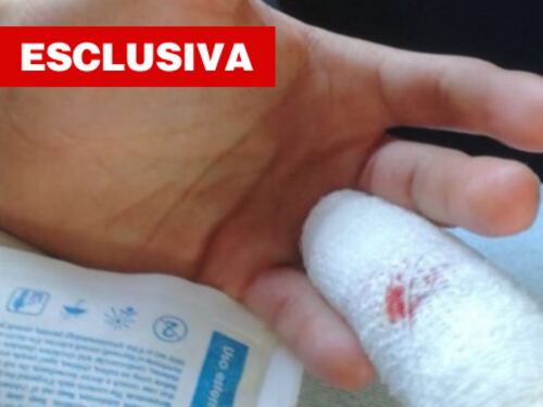 Torino, nigeriano morde poliziotto e gli strappa la falange