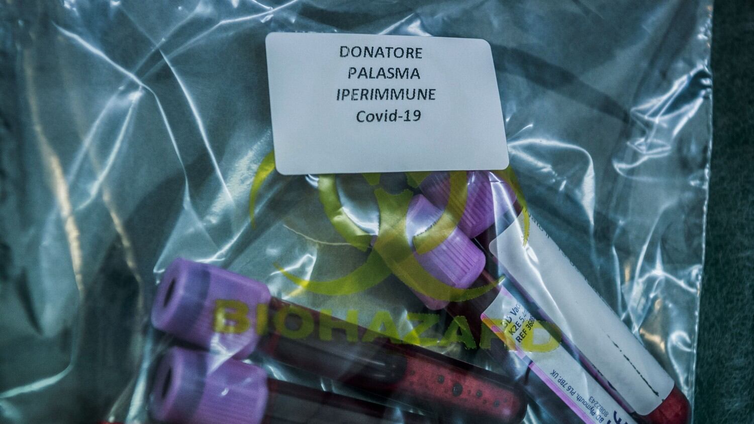 28enne incinta guarita col plasma iperimmune: primo caso al mondo