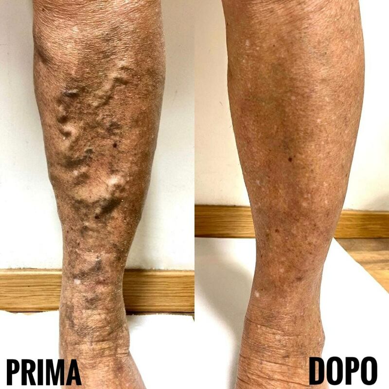 Vene varicose e safene prima e dopo Varixio