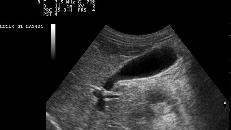 Prevenzione, sintomi, cure: cosa sapere sul tumore alla cistifellea. Allarme tra gli under 50