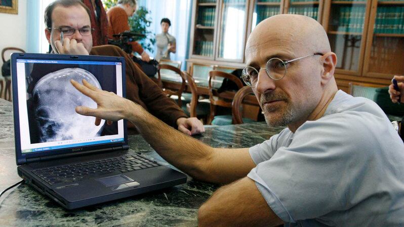 Trapianto di testa? "Possibile entro il 2017"