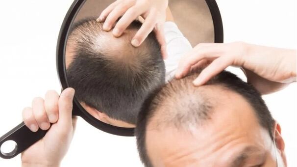 Caduta dei capelli nell'uomo: le cause e i rimedi