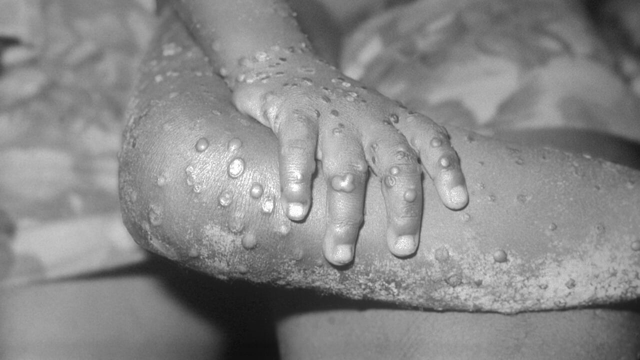 Vaiolo delle scimmie, confermato il primo caso in Europa: cos'è Clade I, il tipo più grave