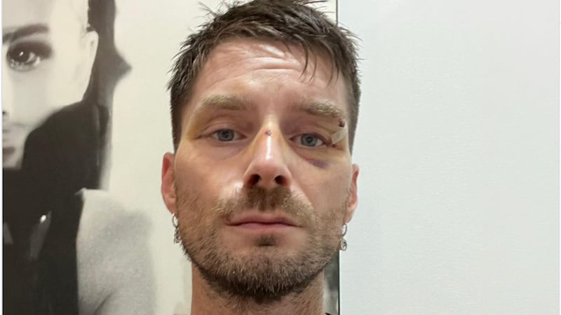 Pugni in faccia e poi la rapina: direttore di Novella 2000 aggredito a Milano da tre ventenni