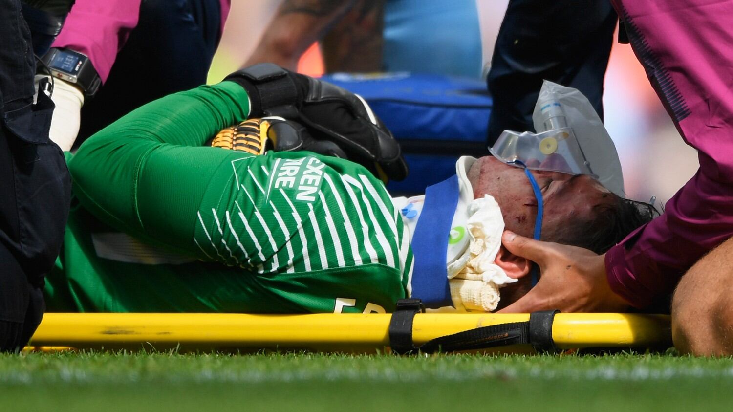 Fallo killer di Mané su Ederson: ecco come è ridotta la faccia del portiere
