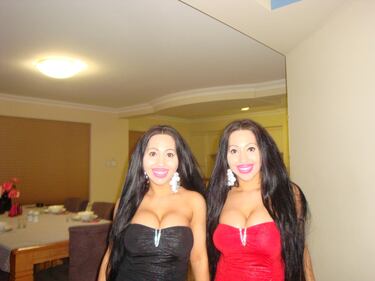 Australia, chirurgo rende perfettamente identiche due gemelle 2