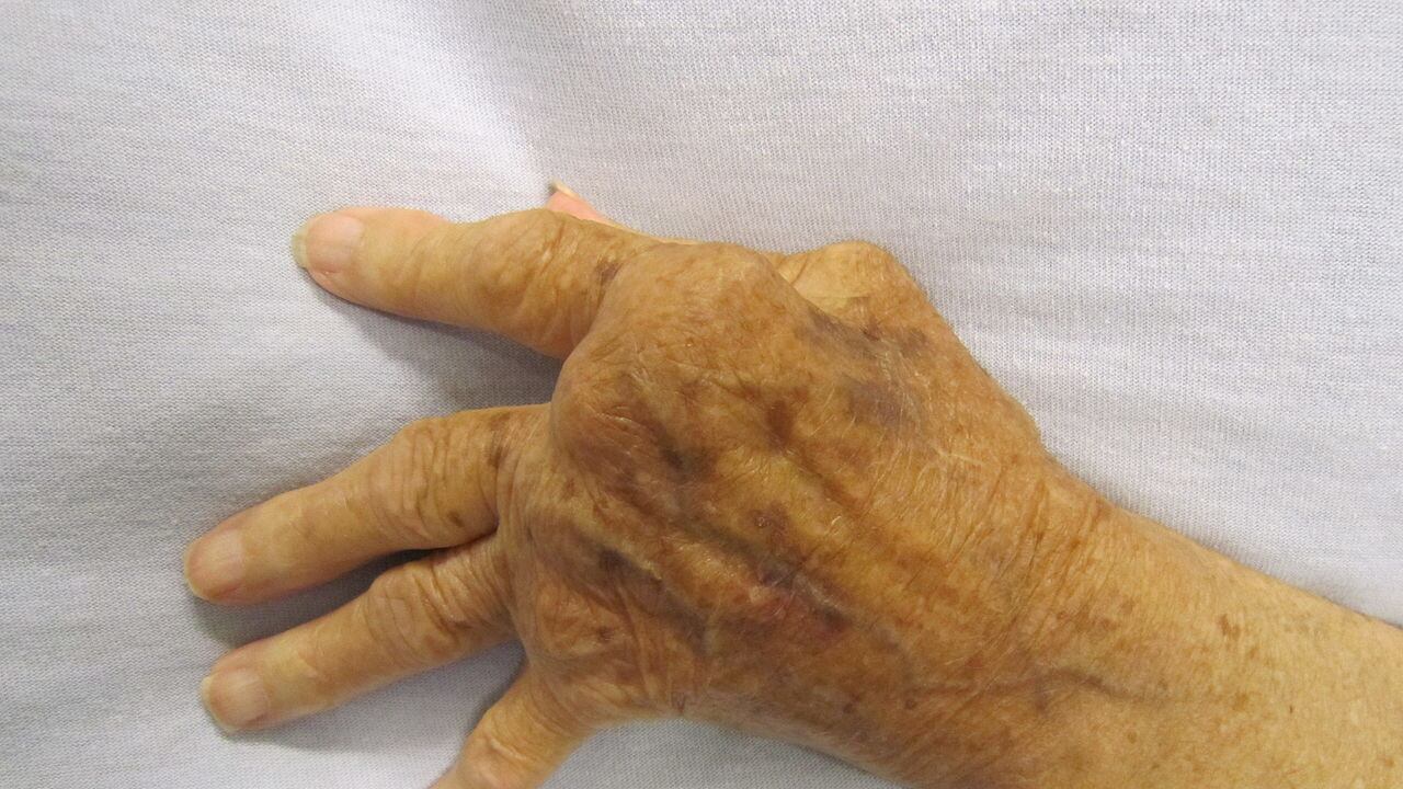 Il campanello d'allarme dell'artrite remautoide: ecco come anticiparla