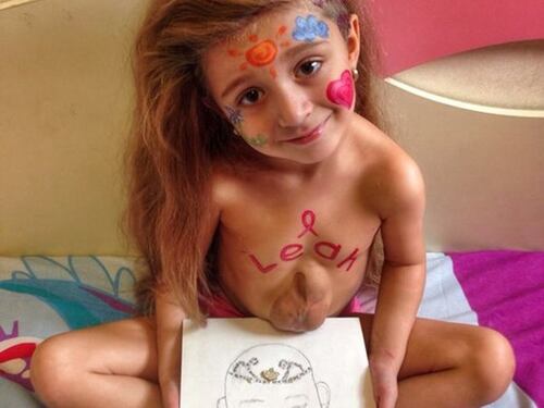 Virsaviya, la bambina con il cuore fuori dal petto che i medici davano per spacciata