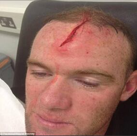 Rooney pubblica le foto del suo infortunio e sul web scatta la satira 6