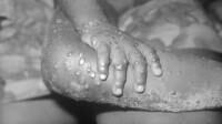 "Sembrava un'influenza..." Ecco come hanno scoperto il paziente zero del vaiolo delle scimmie