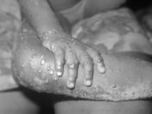 "Sembrava un'influenza..." Ecco come hanno scoperto il paziente zero del vaiolo delle scimmie