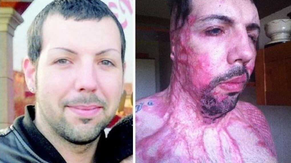 William Pezzullo sfregiato con l'acido: "Giustizia di serie b se la vittima è un uomo"
