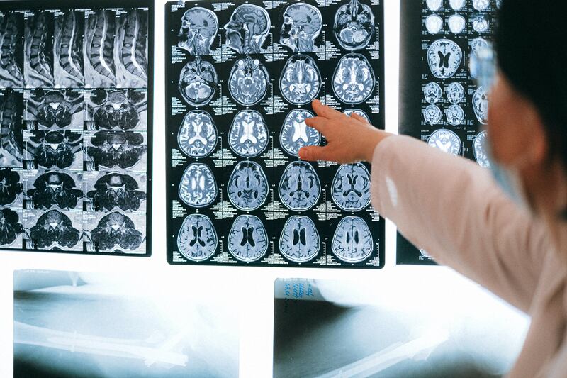 Il Covid-19 può danneggiare temporaneamente il cervello: lo studio italiano