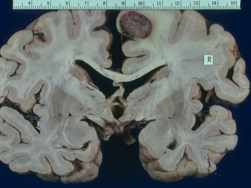 Tumore al cervello, in Italia circa 6mila diagnosi ogni anno: ecco quali sono i sintomi