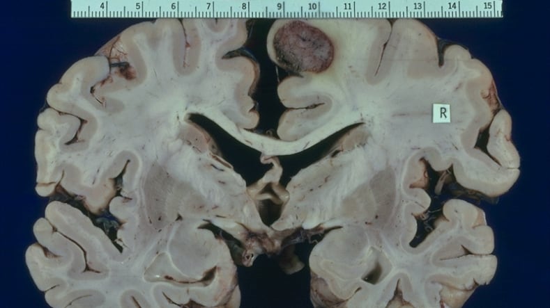 Medulloblastoma, la fenformina può contrastarlo