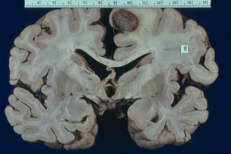 Tumore al cervello, in Italia circa 6mila diagnosi ogni anno: ecco quali sono i sintomi
