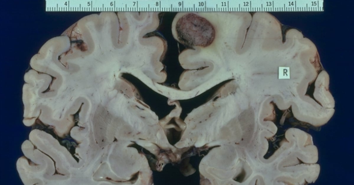 Photo: il Giornale Medulloblastoma, la fenformina può contrastarlo